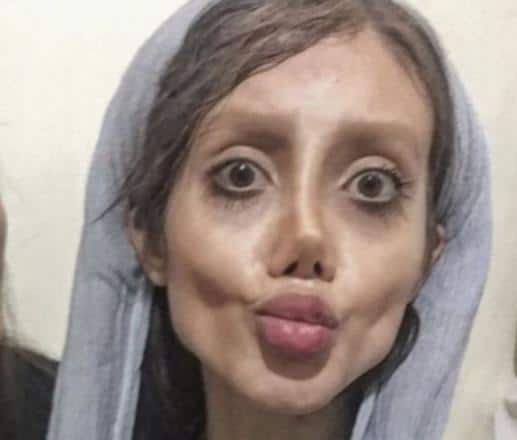 Teen Dubbed &#8220;Corpse Bride&#8221; Had 50 Surgeries Just To Look Like Angelina Jolie