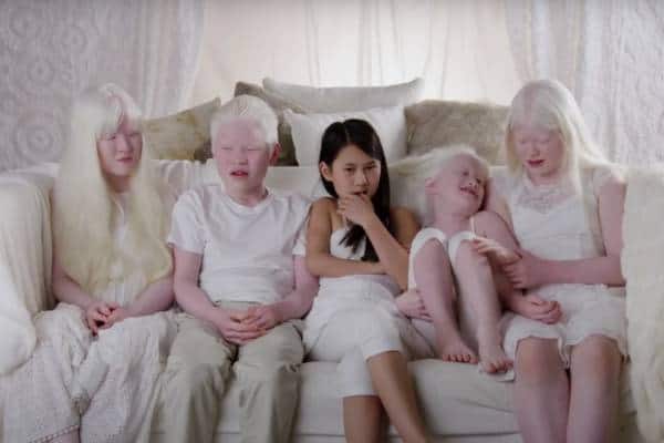 10 Things You Didn’t Know about “Born With Albinism”