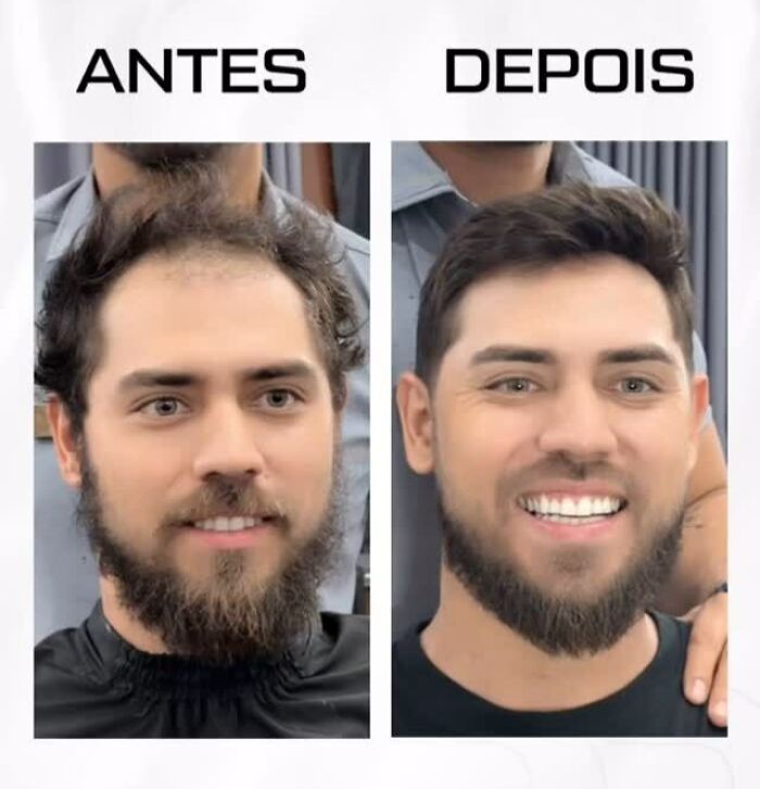 These 40 Men Got Non Surgical Hair Makeovers, And The Results Are Shockingly Natural Looking