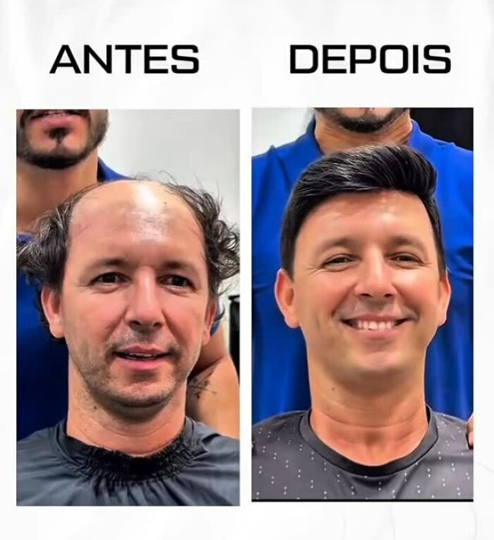 These 40 Men Got Non Surgical Hair Makeovers, And The Results Are Shockingly Natural Looking