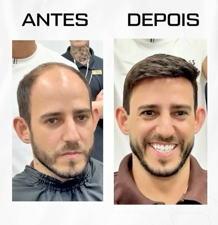 These 40 Men Got Non Surgical Hair Makeovers, And The Results Are Shockingly Natural Looking