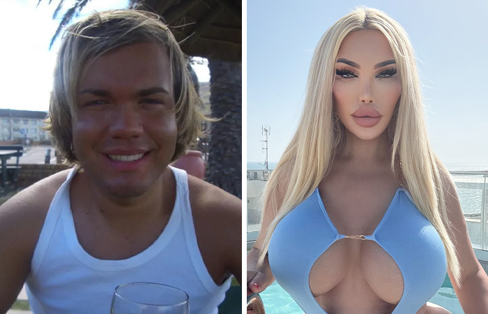 20 Ordinary Lives Changed By Extreme Plastic Surgery