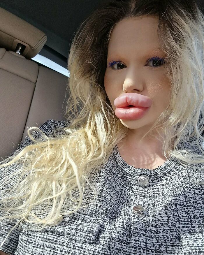 Woman With &#8216;World’s Biggest Lips&#8217; Shares What She Looked Like Before $26K Extreme Surgeries