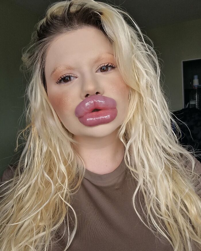 Woman With &#8216;World’s Biggest Lips&#8217; Shares What She Looked Like Before $26K Extreme Surgeries