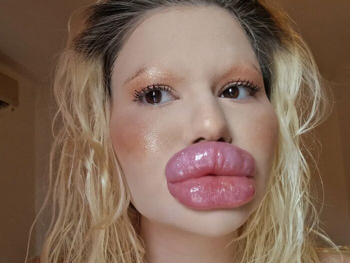 Woman With &#8216;World’s Biggest Lips&#8217; Shares What She Looked Like Before $26K Extreme Surgeries