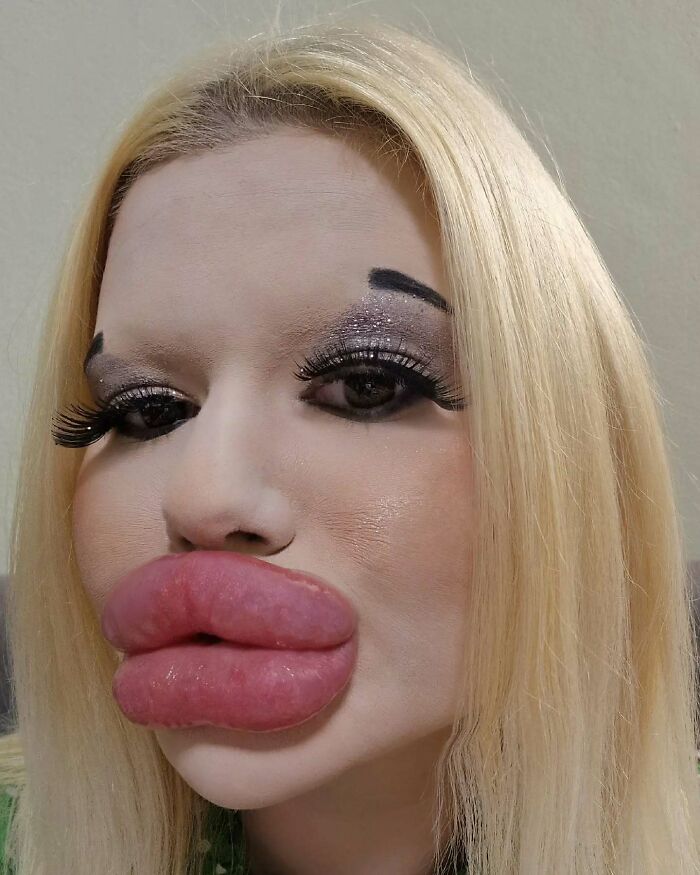 Woman With &#8216;World’s Biggest Lips&#8217; Shares What She Looked Like Before $26K Extreme Surgeries