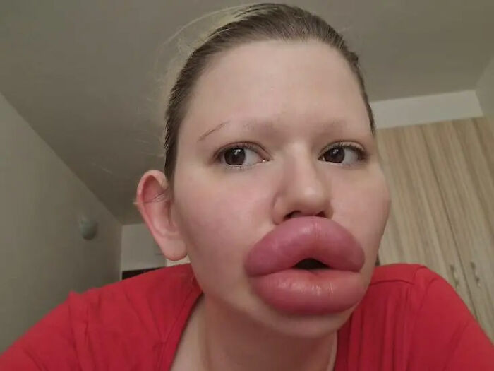 Woman With &#8216;World’s Biggest Lips&#8217; Shares What She Looked Like Before $26K Extreme Surgeries
