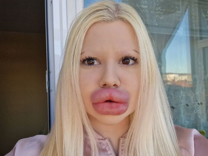 Woman With &#8216;World’s Biggest Lips&#8217; Shares What She Looked Like Before $26K Extreme Surgeries
