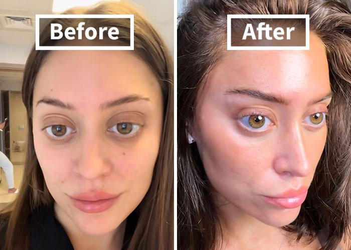 “I’m Honestly Terrified”: 28YO Gets A Facelift, People Are Questioning Reality