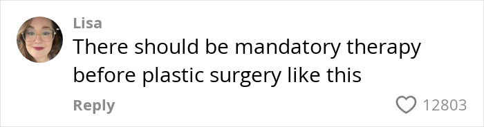“I’m Honestly Terrified”: 28YO Gets A Facelift, People Are Questioning Reality