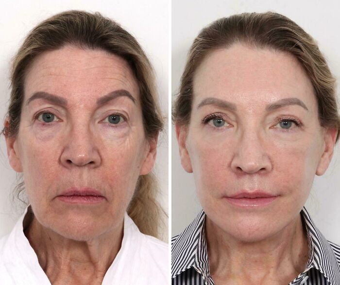 80 Plastic Surgery Transformations That Changed Ordinary Lives Forever