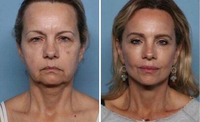 80 Plastic Surgery Transformations That Changed Ordinary Lives Forever
