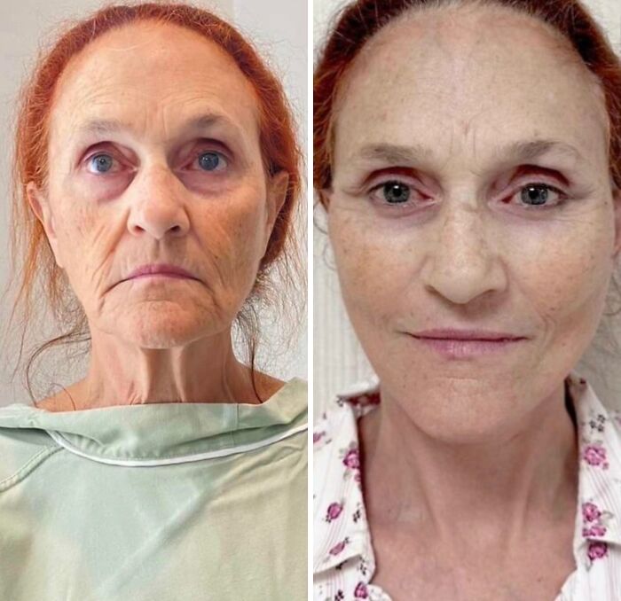 80 Plastic Surgery Transformations That Changed Ordinary Lives Forever