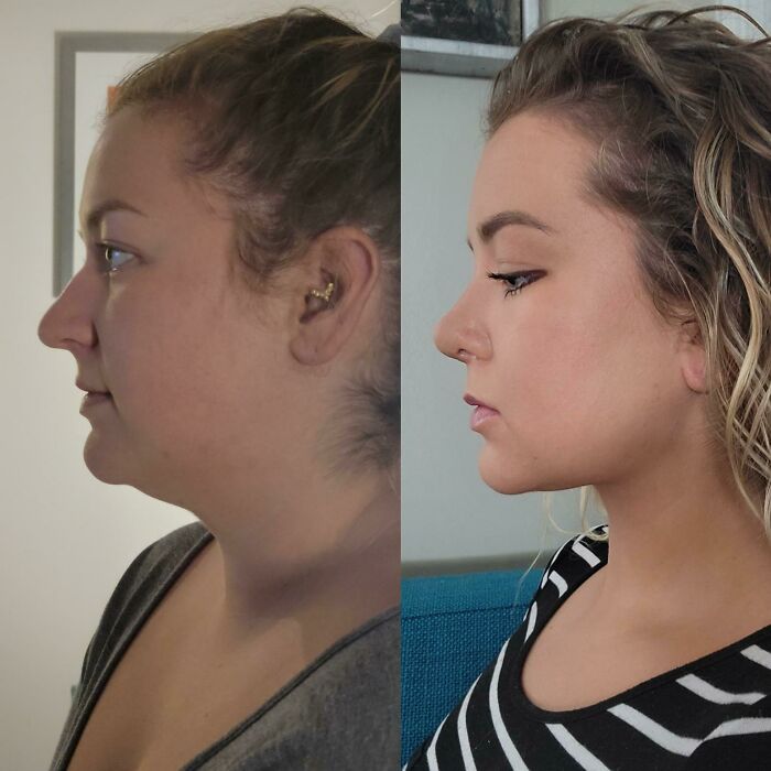 80 Plastic Surgery Transformations That Changed Ordinary Lives Forever