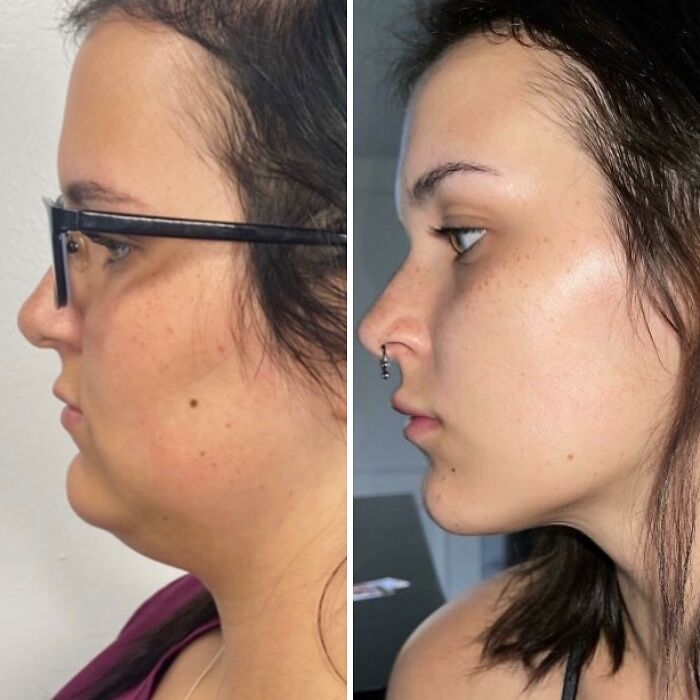 80 Plastic Surgery Transformations That Changed Ordinary Lives Forever