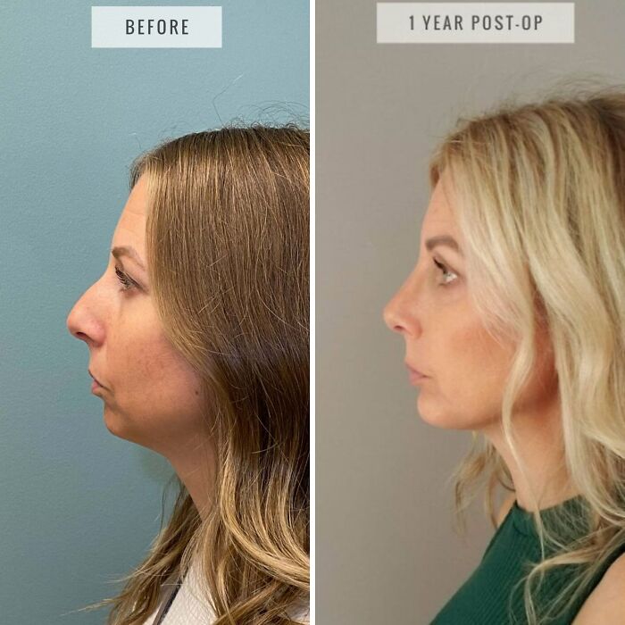 80 Plastic Surgery Transformations That Changed Ordinary Lives Forever