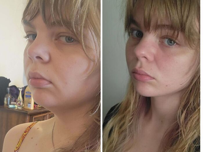 80 Plastic Surgery Transformations That Changed Ordinary Lives Forever