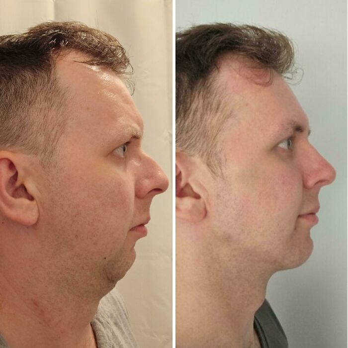 80 Plastic Surgery Transformations That Changed Ordinary Lives Forever
