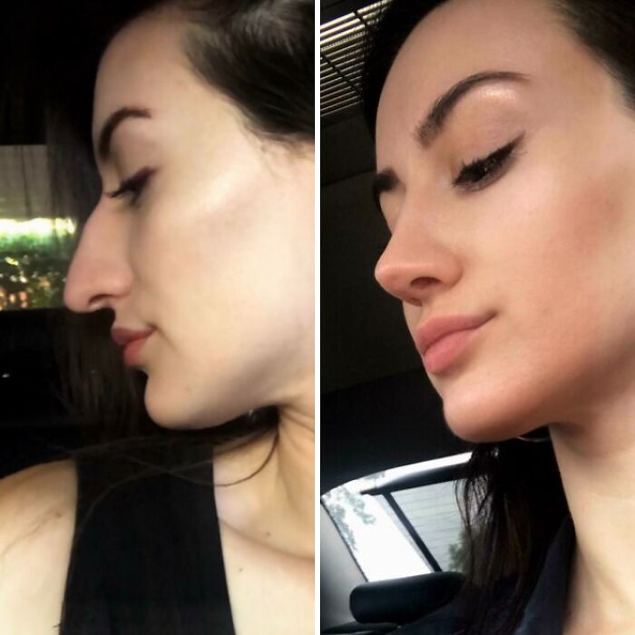 80 Plastic Surgery Transformations That Changed Ordinary Lives Forever