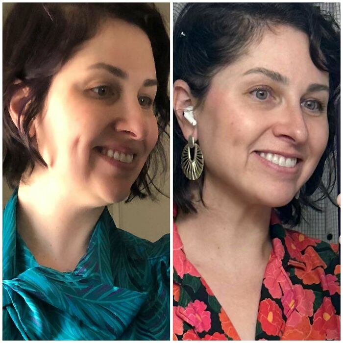 80 Plastic Surgery Transformations That Changed Ordinary Lives Forever