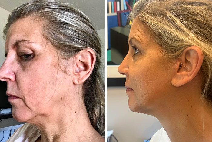 80 Plastic Surgery Transformations That Changed Ordinary Lives Forever