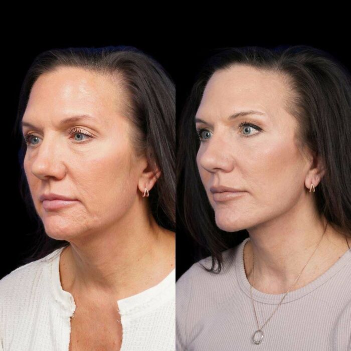 80 Plastic Surgery Transformations That Changed Ordinary Lives Forever