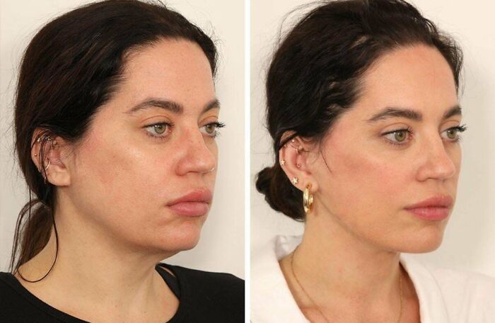 80 Plastic Surgery Transformations That Changed Ordinary Lives Forever