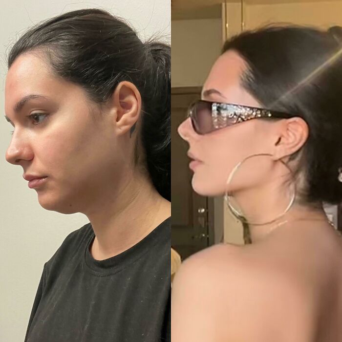 80 Plastic Surgery Transformations That Changed Ordinary Lives Forever