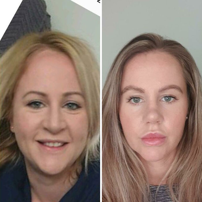 80 Plastic Surgery Transformations That Changed Ordinary Lives Forever