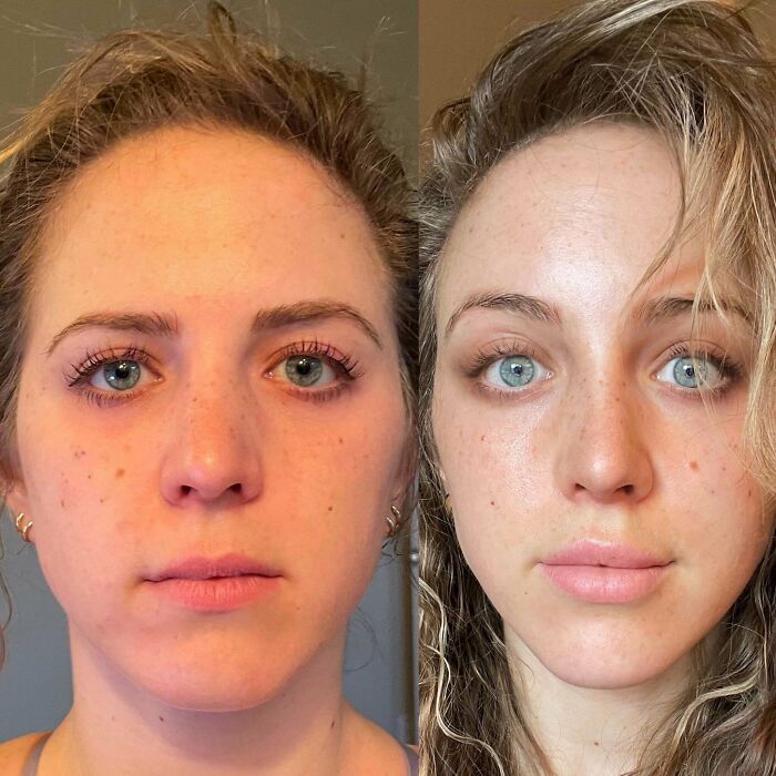 80 Plastic Surgery Transformations That Changed Ordinary Lives Forever