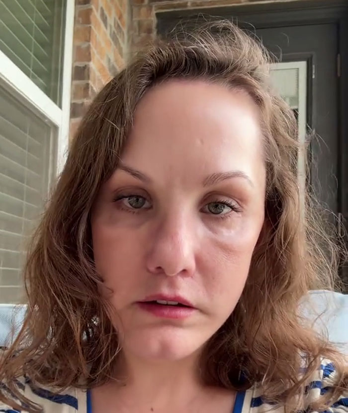 51YO Documents Progress Of Her Facelift, Leaves 125 Million People Baffled Over Results