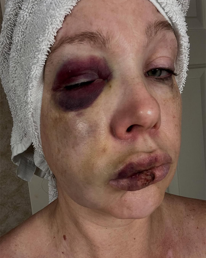 Gruesome Photos Of Cincinnati Brawl Victim’s Swollen Face Spark Outrage As Racial Tensions Erupt