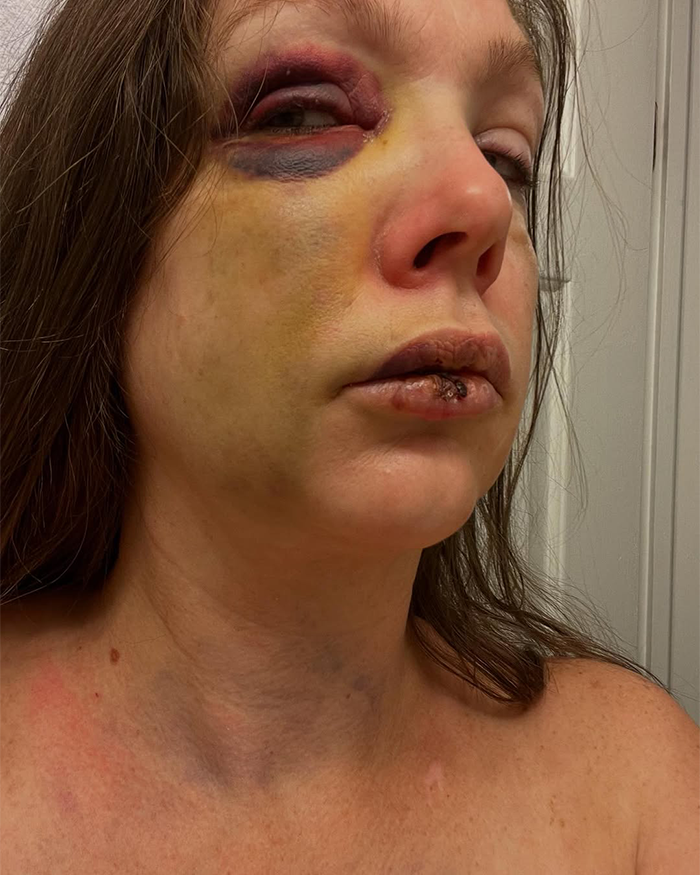 Gruesome Photos Of Cincinnati Brawl Victim’s Swollen Face Spark Outrage As Racial Tensions Erupt