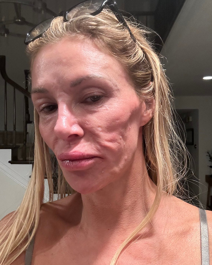 Brandi Glanville Chemically Burns Her Face Desperately Trying To Remove &#8216;Parasite&#8217;