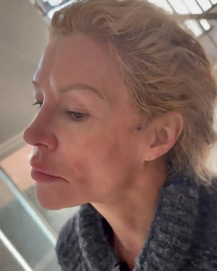 Brandi Glanville Chemically Burns Her Face Desperately Trying To Remove &#8216;Parasite&#8217;