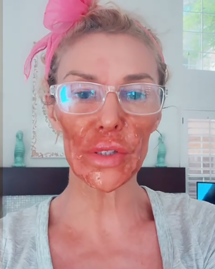 Brandi Glanville Chemically Burns Her Face Desperately Trying To Remove &#8216;Parasite&#8217;