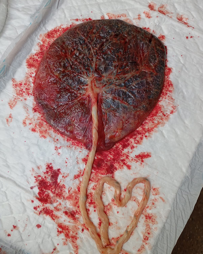 Calvin Harris Divides Fans After Posting Graphic Placenta Photos in Birth Announcement