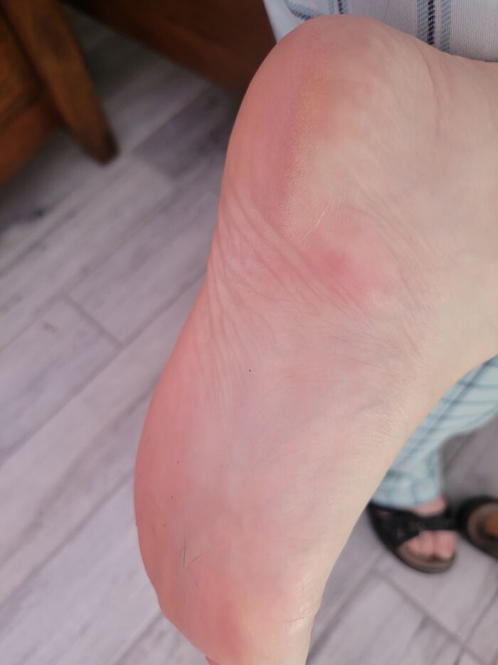 Hey Pandas, What Was The Worst Place You&#8217;ve Gotten Bitten By A Bug Or Insect