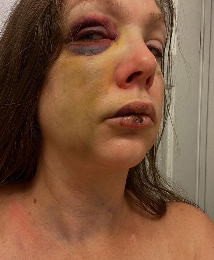&#8220;The City Of Cincinnati Should Be Ashamed&#8221;: Mass Support For Woman Beaten After New Interview