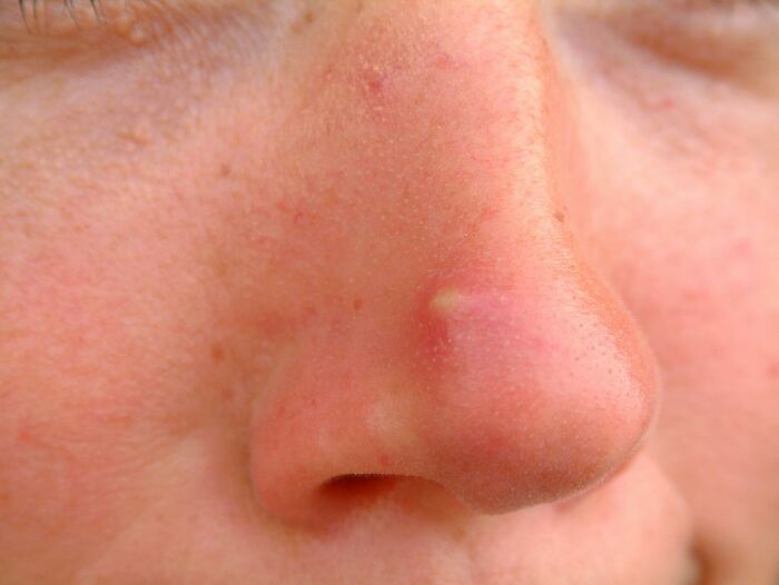 Mom Ends Up in Urgent Care After Popping Pimple In The “Triangle Of Death”