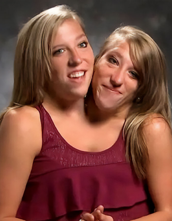 TLC’s Abby &#038; Brittany Hensel Resurface—This Time With A Baby