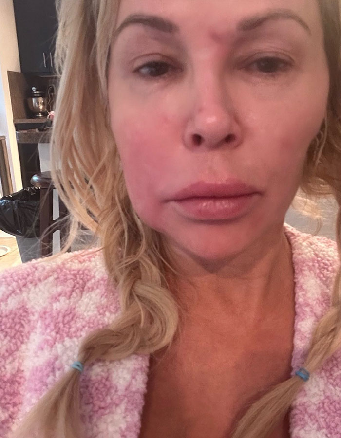 Brandi Glanville Reveals New Smile After $130K Health Battle And Face-Disfiguring Parasite
