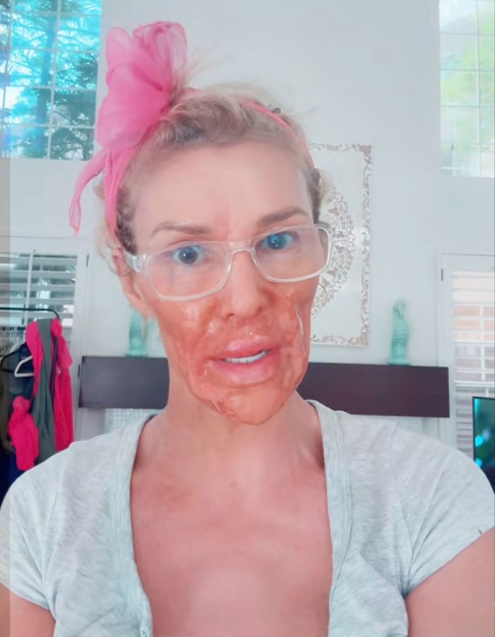 Brandi Glanville Reveals New Smile After $130K Health Battle And Face-Disfiguring Parasite