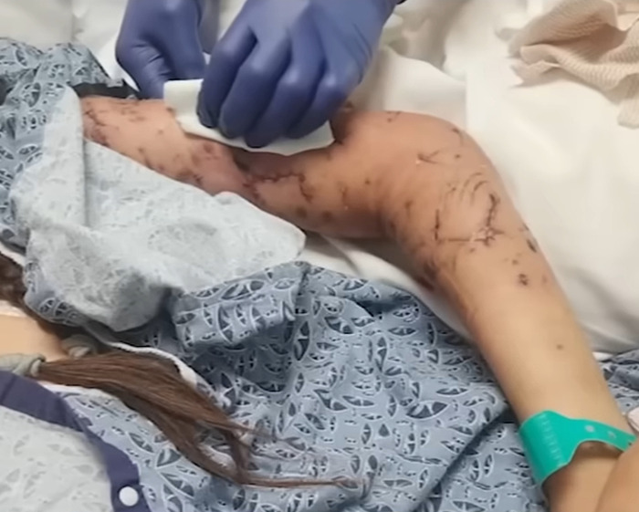 Teen Daughter&#8217;s Heartbreaking Question To Mom After Being Mauled By Pack Of Dogs