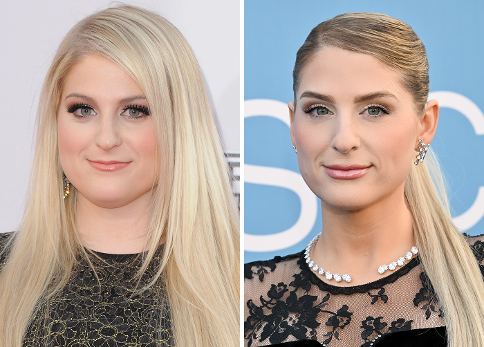 15 Before-And-After Photos Of Celebs Who Replaced Regular Botox With “Lip Flip” For A New Kind Of Look