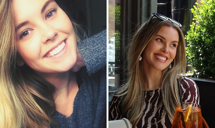 15 Before-And-After Photos Of Celebs Who Replaced Regular Botox With “Lip Flip” For A New Kind Of Look