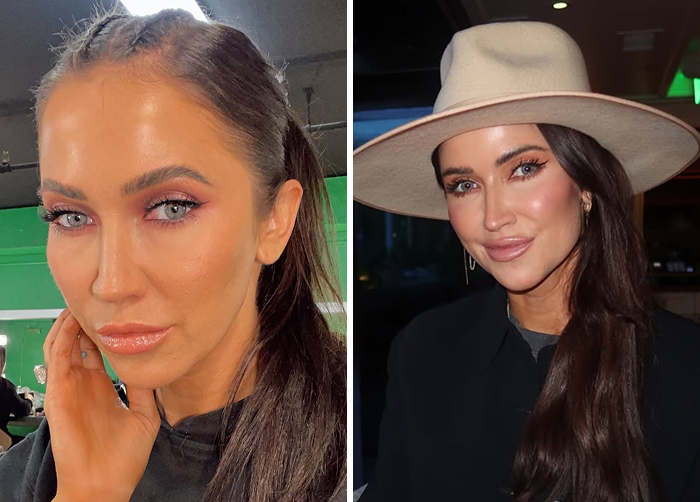 15 Before-And-After Photos Of Celebs Who Replaced Regular Botox With “Lip Flip” For A New Kind Of Look