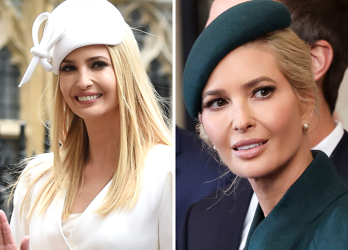 15 Before-And-After Photos Of Celebs Who Replaced Regular Botox With “Lip Flip” For A New Kind Of Look