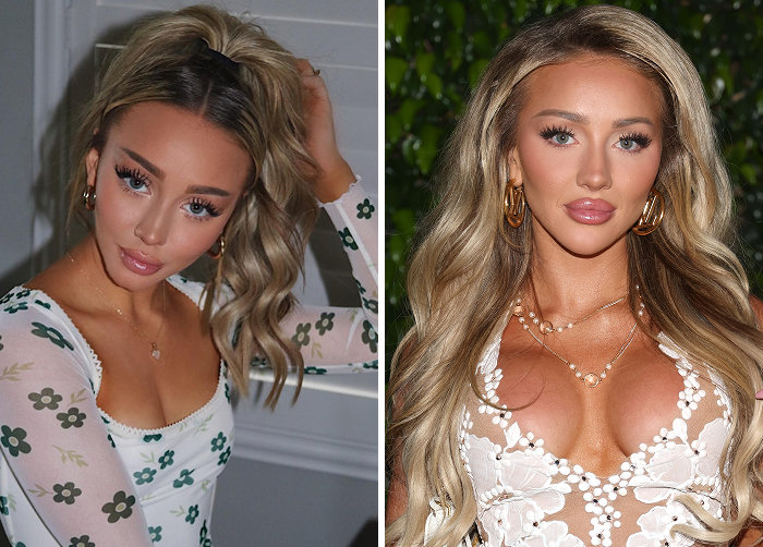 15 Before-And-After Photos Of Celebs Who Replaced Regular Botox With “Lip Flip” For A New Kind Of Look