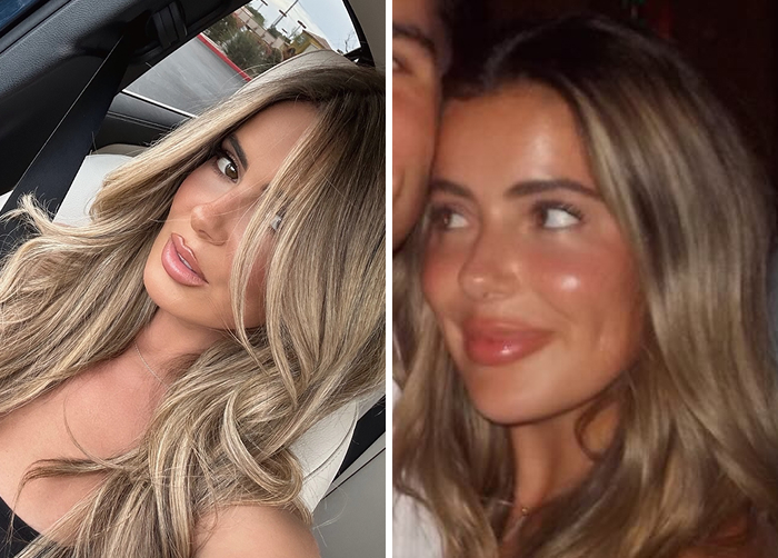 15 Before-And-After Photos Of Celebs Who Replaced Regular Botox With “Lip Flip” For A New Kind Of Look